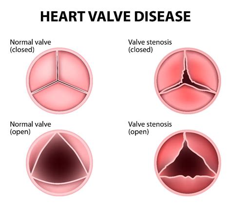 Frequently Asked Questions About Heart Valve Disease - Facty Health