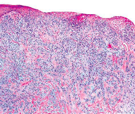 Pathology Outlines - Trichilemmoma