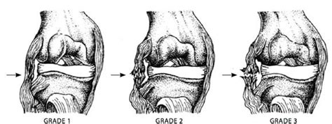 Management of Ligament Injuries | The Physio Lounge | Manchester | Warrington