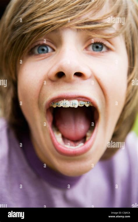 Teenage boy montrant les attelles, close-up Photo Stock - Alamy