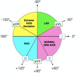 Right Axis Deviation (RAD) • LITFL • ECG Library Diagnosis