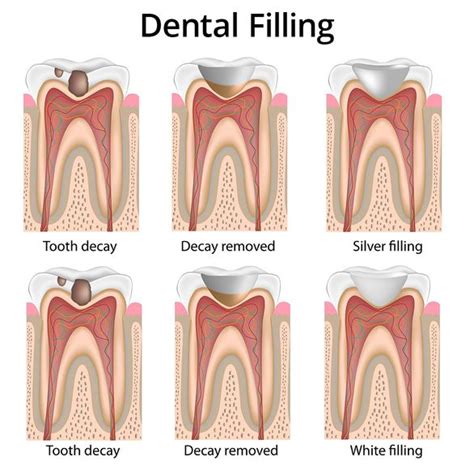 Toothache Pain | What Causes Tooth Pain & Teeth Aching