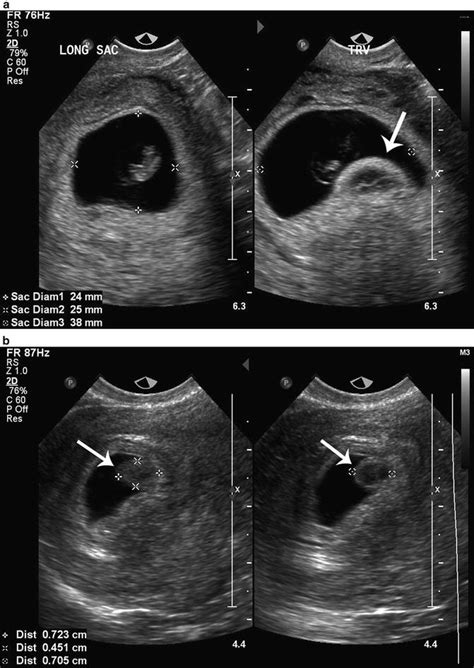 Amniotic Sac Ultrasound