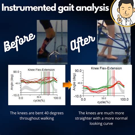 Gait optimisation surgery in Cerebral Palsy