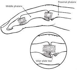 Volar Plate Injuries - Definition, Causes, Symptoms & Treatment