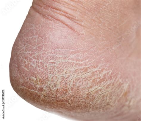 dry skin on the legs with cracks - Acheter cette photo libre de droit et découvrir des images ...