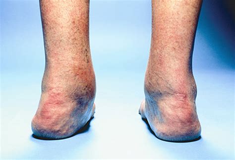 Ankle Arthritis Symptoms, Causes, and Treatments | OrthofootMD