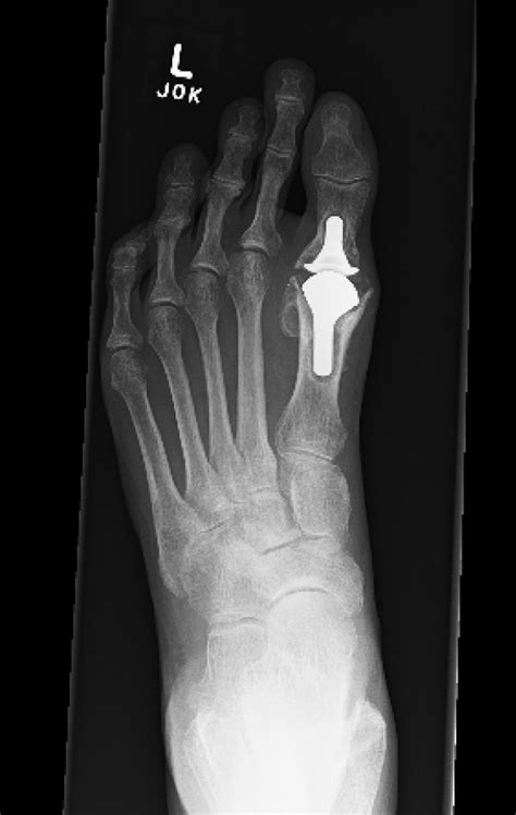 Case Discussion: First Metatarsophalangeal Joint Replacement Conversion to a Fusion