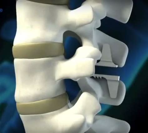 The coflex® Interlaminar Stabilization procedure | Dr. Mark Giovanini - Neuromicrospine