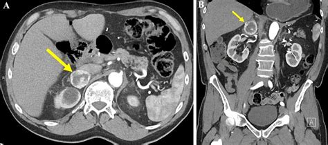 Axial (A) and coronal (B) arterial phase CT images showing a 4 cm ...