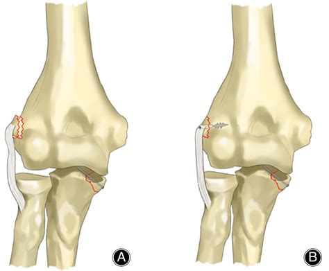 Repair Versus Non‐Repair of Lateral Ulnar Collateral Ligament in Elbow Varus Posteromedial ...