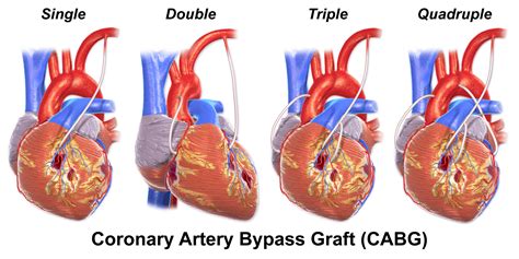 Coronary Artery Bypass Grafting (CABG) - almostadoctor