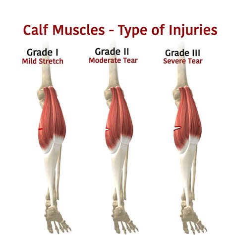 Calf Muscle Tears: Symptoms, Complications, and Treatments | Physio Fit ...