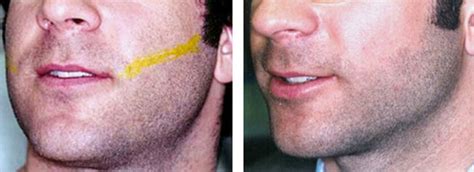 Laser Hair Removal Before & After Photos NYC