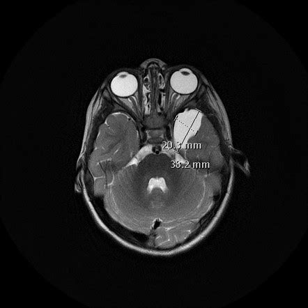 Arachnoid cyst - middle cranial fossa | Image | Radiopaedia.org