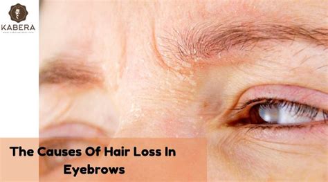 The causes of hair loss in eyebrows | Eyebrows, Losing eyebrows, Problem hair loss