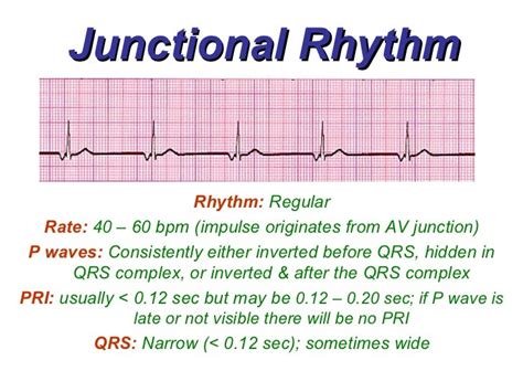 Junctional Rhythms - BMH/Tele