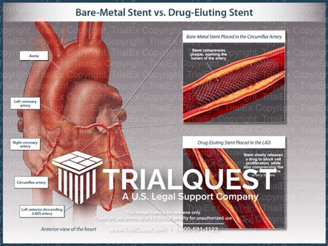 Bare-Metal Stent vs Drug-Eluting Stent - TrialExhibits Inc.