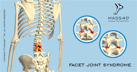 What is Facet Joint Syndrome?