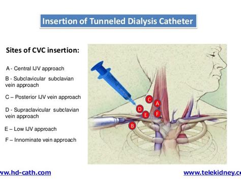 Tunneled Central Venous Catheter Placement