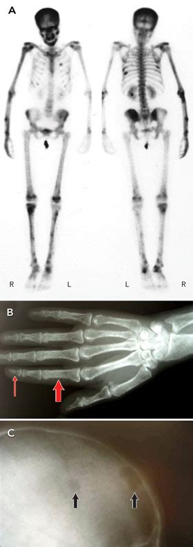 Osteitis Fibrosa Cystica; Recklinghausen's Disease of Bone