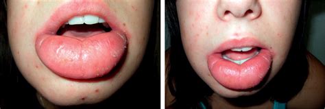 Persistent swollen lip: cheilitis granulomatosa - The Lancet