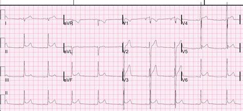 Dr. Smith's ECG Blog: Inferior ST Elevation: what is the Diagnosis?