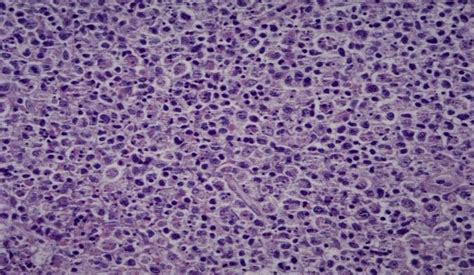 H&E 100x, cervical lymph node biopsy section showing the appearance of ...