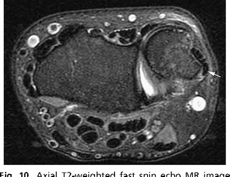 Figure 10 from Imaging the distal radioulnar joint. | Semantic Scholar