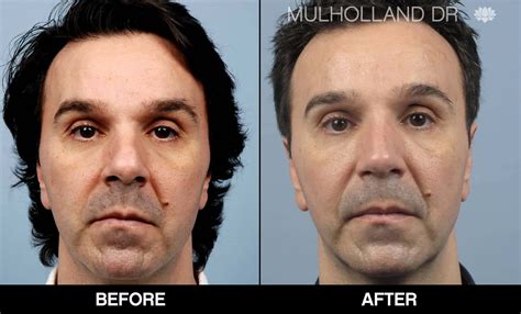 Male Rhinoplasty Before & After Photo Gallery | TPS