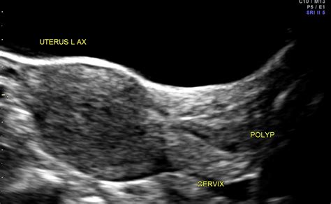 ENDOMETRIAL POLYP WITH A STALK PRESENTING IN THE CERVIX | Looking Through a Transducer