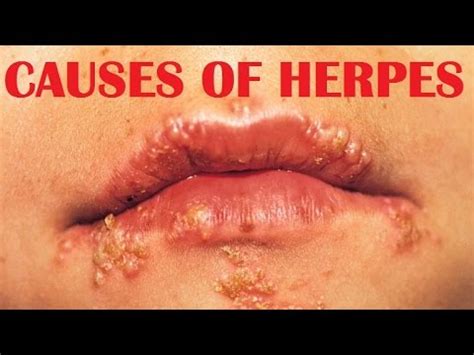 Herpes symptoms – buzzpls.Com