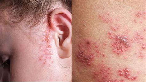 10 Rashes That Could Reveal a Dermatologic Disease » | Types of rashes ...