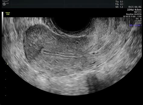 [36+] Uterine Cancer Ultrasound Endometrial Hyperplasia