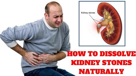 The Kidney Stone Removal Report Review - How To Dissolve Kidney Stones Naturally - YouTube