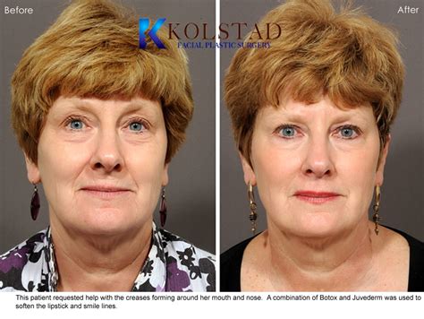 Combining Juvederm & Botox to Correct Lipstick Lines & Smile Lines Gallery 32 | Dr. Kolstad ...