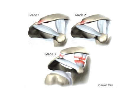 Acromioclavicular Joint Pain - Shoulder Pain - Complete Physio