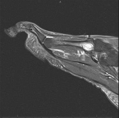 Intraosseous ganglion of the third metatarsal: A case report | The Foot ...