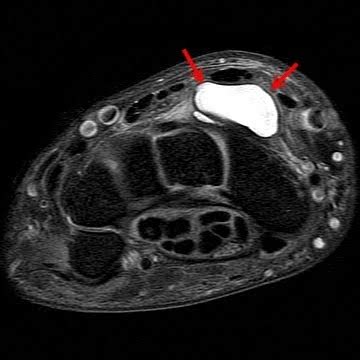 MRI Procedures Course 415-Spring 2010: Ganglion Cyst