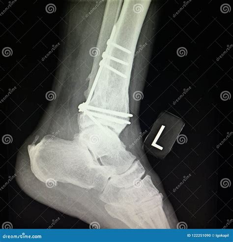 Tibia Fracture Treatment