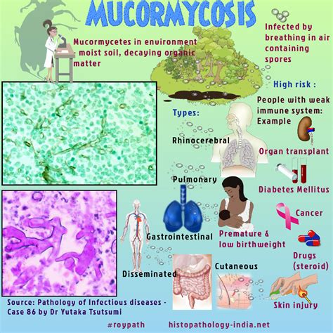 Mucormycosis (previously called zygomycosis) is a rare, potentially life-threatening ...