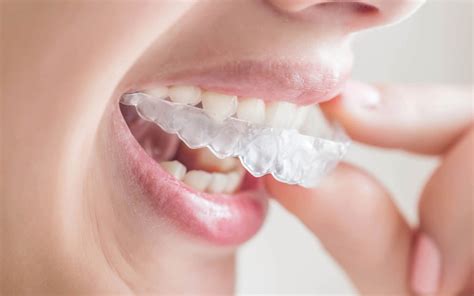 Invisalign Braces - Priority Dental Group