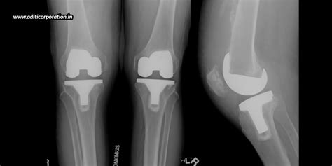 Things To Take Care Of When You Undergo Bilateral Total Knee Arthroplasty - Aditi Corporation