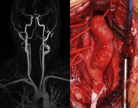 Post-traumatic Aneurysm of the Left Internal Carotid Artery - European Journal of Vascular and ...