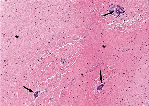 Odontogenic Myxoma Histology