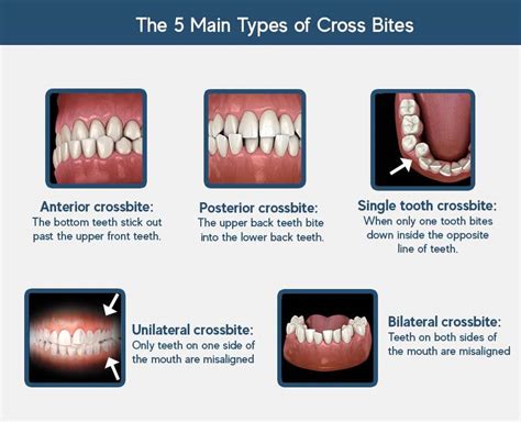 how to fix a crossbite at home - utworzenia