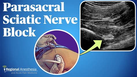 Ultrasound Guided Parasacral Sciatic Nerve Block - YouTube