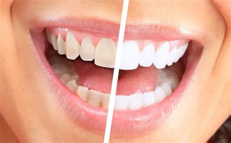 Best Teeth Whitening Kit (Products) in 2018