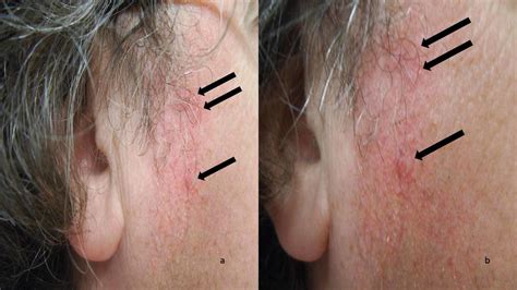 Cureus | Discoid Lupus Erythematosus Lesions Associated with Systemic Fluorouracil Agents: A ...