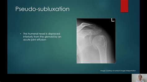 Shoulder x-ray interpretation - YouTube